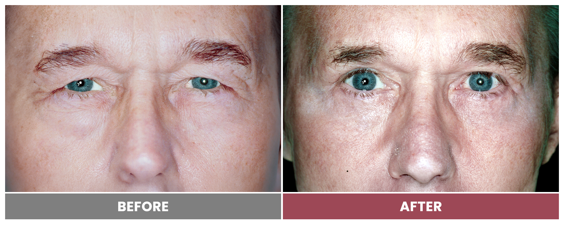 Upper Blepharoplasty - Case 51